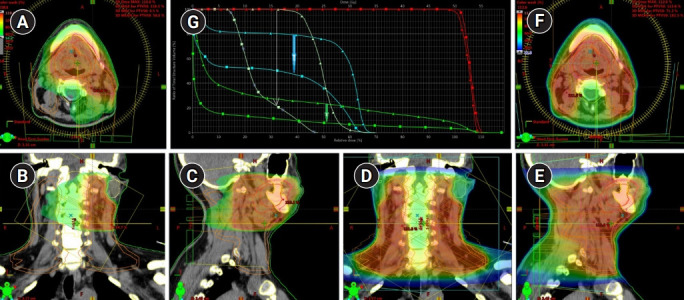 Single photon emission computed tomography-computed tomography visualization of sentinel lymph nodes for lymph flow guided nodal irradiation in oral tongue cancer.