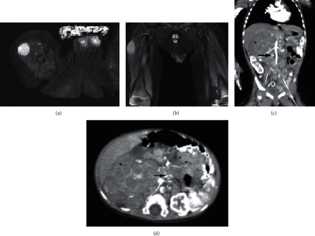 Neuroblastoma Soft Tissue Metastasis in a 10-Month-Old Infant with a Right Thigh Mass.