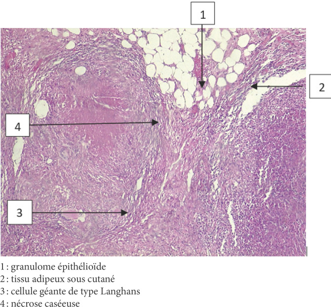 [Tuberculosis of the chest wall: Report of a case at the Joseph Ravoahangy Andrianavalona Teaching Hospital, Antananarivo, Madagascar].