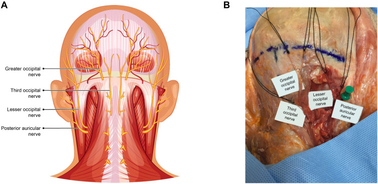 Efficacy and Safety of Cryoneurolysis for Treatment of Chronic Head Pain Secondary to Occipital Neuralgia: A Pilot Study.