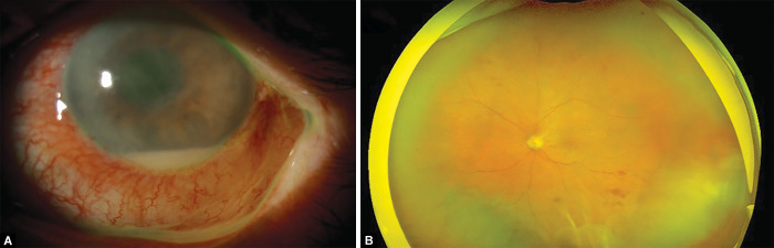 Late-onset Endophthalmitis after XEN45<sup>®</sup> Implantation: A Retrospective Case Series and Literature Review.