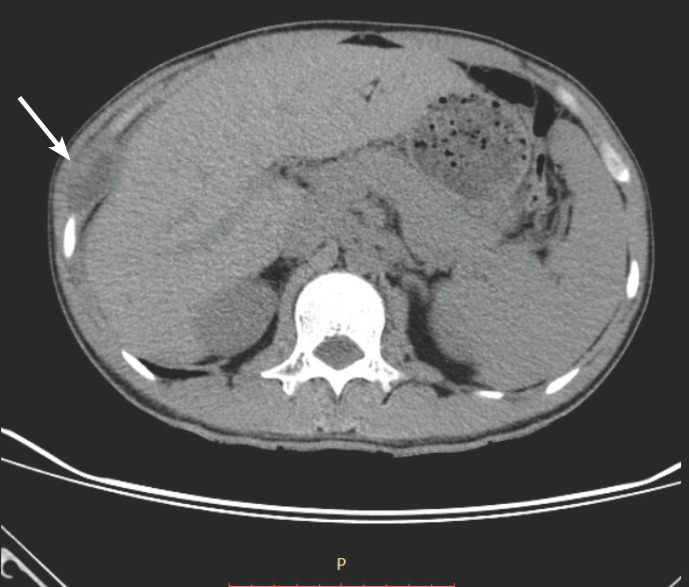 [Tuberculosis of the chest wall: Report of a case at the Joseph Ravoahangy Andrianavalona Teaching Hospital, Antananarivo, Madagascar].