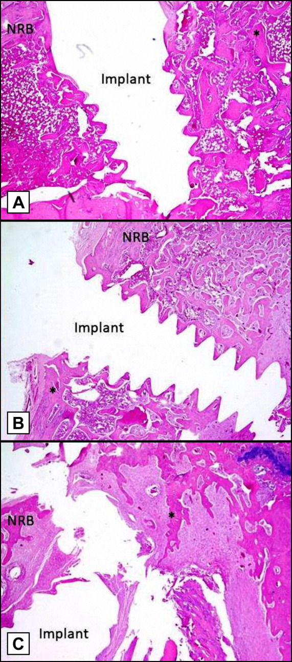 Effects of Systemic Propranolol Application on the New Bone Formation in Periimplant Guided Bone Regeneration.