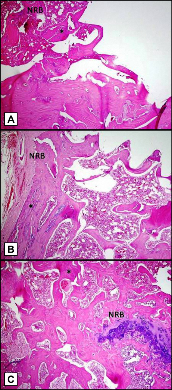 Effects of Systemic Propranolol Application on the New Bone Formation in Periimplant Guided Bone Regeneration.