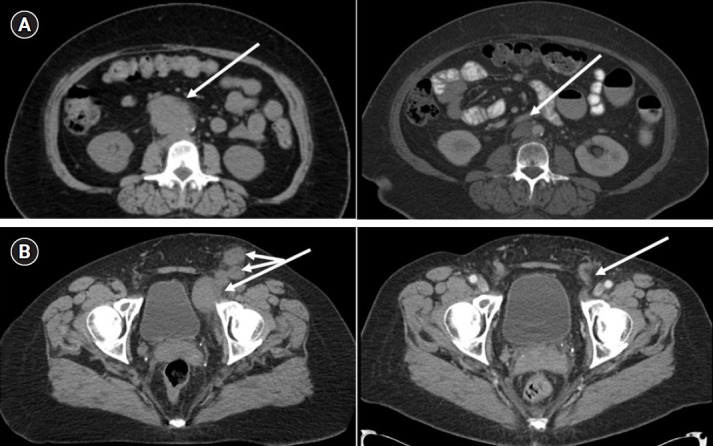 Dose escalated simultaneous integrated boost of gross nodal disease in gynecologic cancers: a multi-institutional retrospective analysis and review of the literature.