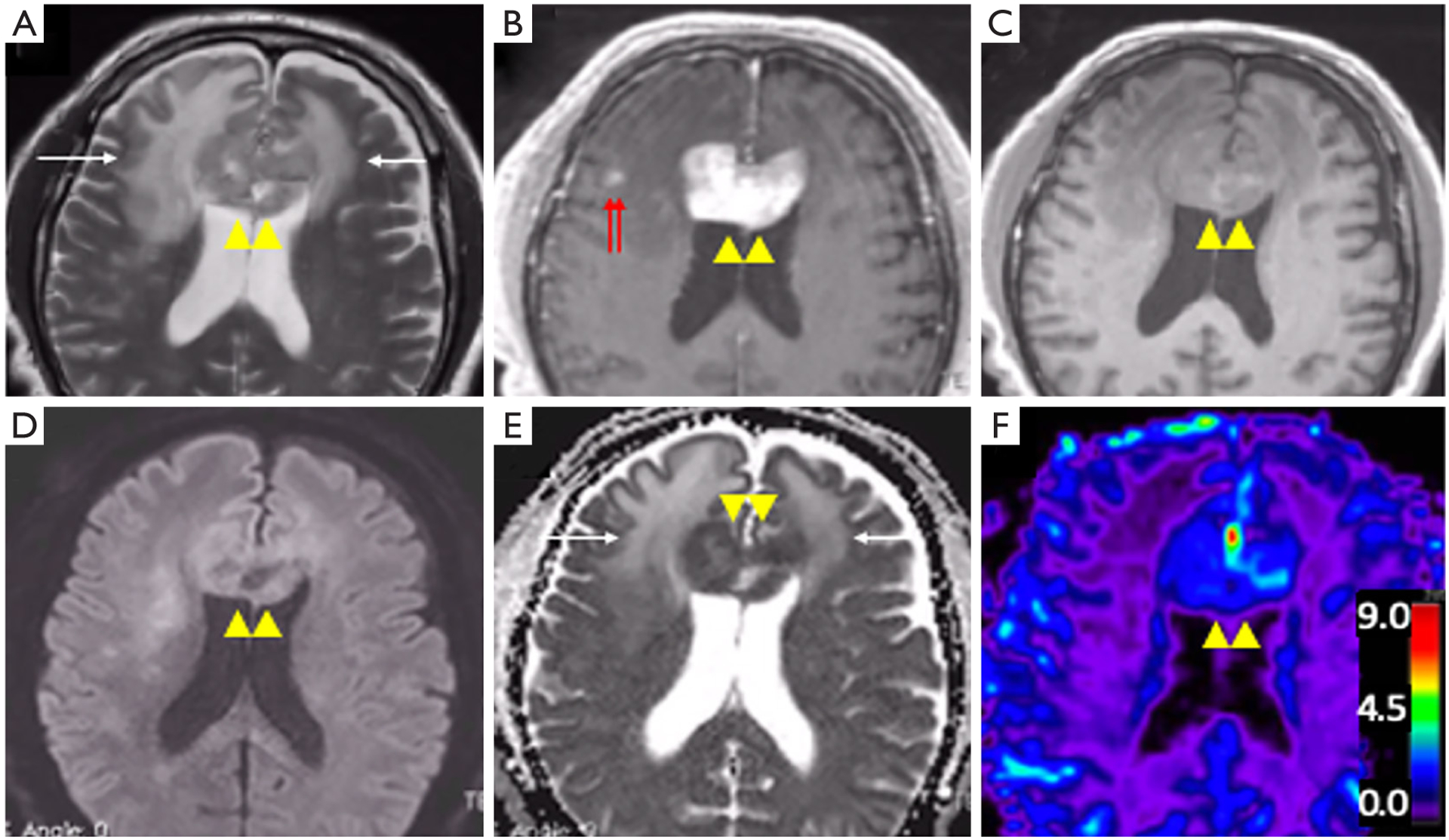 Primary central nervous system lymphoma: advances in MRI and PET imaging.