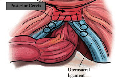 Case Report of a Rare Nonpuerperal Uterine Inversion Managed with Uterosacral Ligament Hysteropexy.