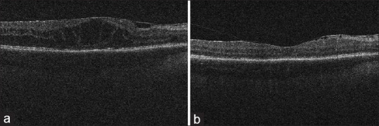 Bromfenac 0.09% for the Treatment of Macular Edema Secondary to Noninfectious Uveitis.