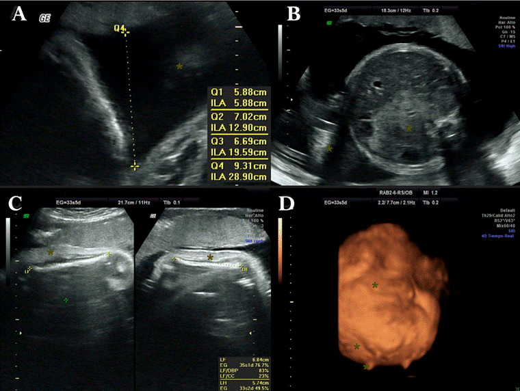 Prenatal ultrasound diagnostic approach to Omenn syndrome: case report