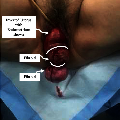 Case Report of a Rare Nonpuerperal Uterine Inversion Managed with Uterosacral Ligament Hysteropexy.