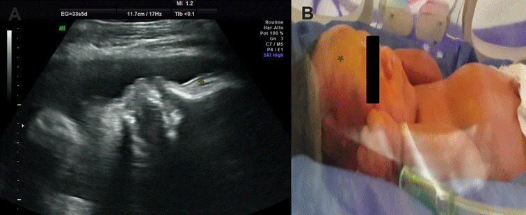 Prenatal ultrasound diagnostic approach to Omenn syndrome: case report