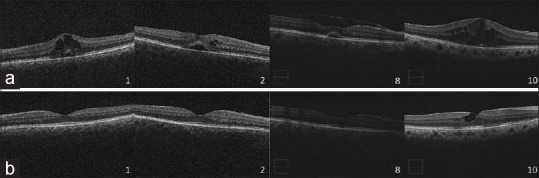 Bromfenac 0.09% for the Treatment of Macular Edema Secondary to Noninfectious Uveitis.