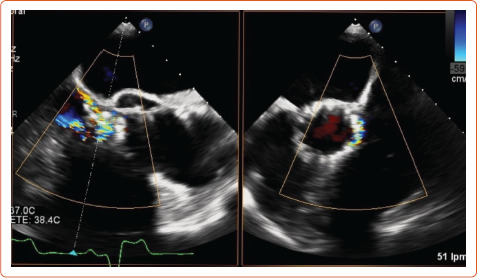 Transcatheter Aortic Valve Implantation and Subclinical and Clinical Leaflet Thrombosis: Multimodality Imaging for Diagnosis and Risk Stratification.