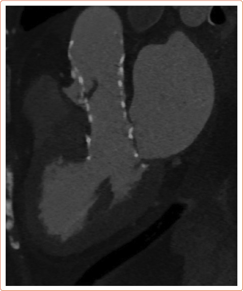 Transcatheter Aortic Valve Implantation and Subclinical and Clinical Leaflet Thrombosis: Multimodality Imaging for Diagnosis and Risk Stratification.