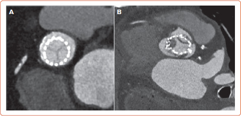 Transcatheter Aortic Valve Implantation and Subclinical and Clinical Leaflet Thrombosis: Multimodality Imaging for Diagnosis and Risk Stratification.