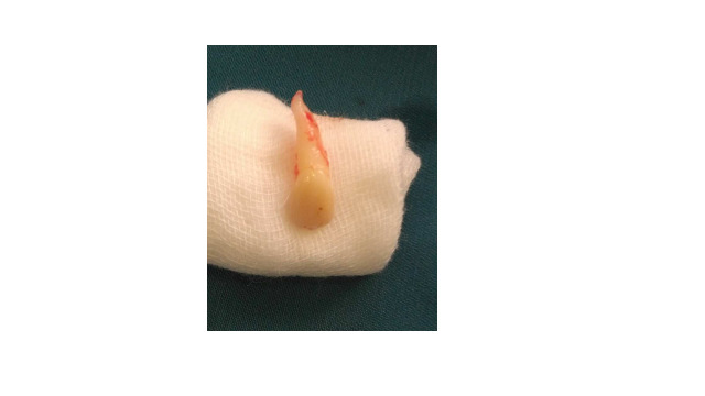 Fusion of Unerupted Mesiodens with a Regular Maxillary Central Incisor: a Diagnostic and Therapeutic Challenge.