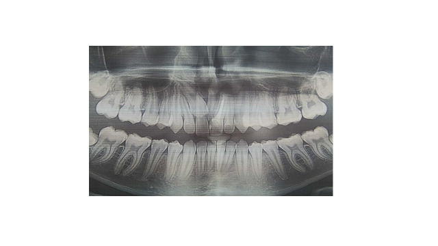 Fusion of Unerupted Mesiodens with a Regular Maxillary Central Incisor: a Diagnostic and Therapeutic Challenge.