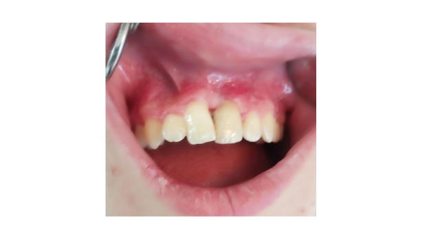 Fusion of Unerupted Mesiodens with a Regular Maxillary Central Incisor: a Diagnostic and Therapeutic Challenge.