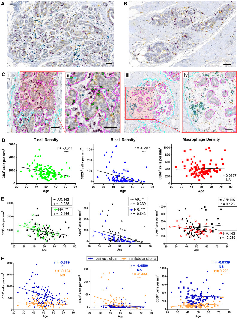 Changes in Immune Cell Types with Age in Breast are Consistent with a Decline in Immune Surveillance and Increased Immunosuppression.