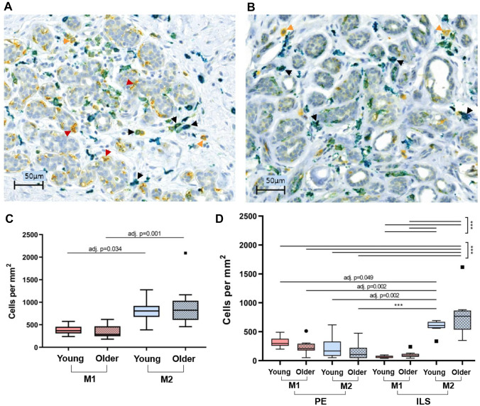 Changes in Immune Cell Types with Age in Breast are Consistent with a Decline in Immune Surveillance and Increased Immunosuppression.