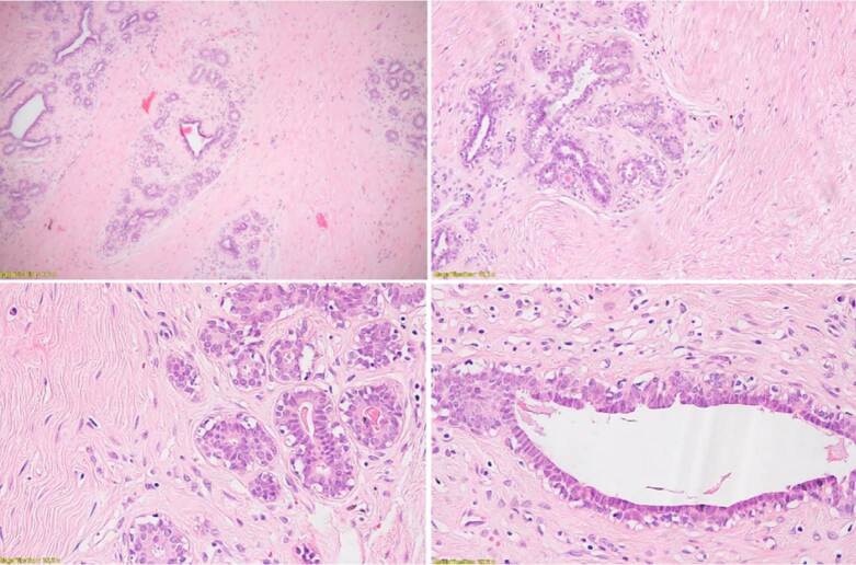 Ectopic mammary tissue in vulva: case report and systematic literature review