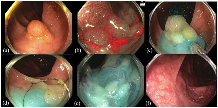 Evolving management of colorectal polyps.