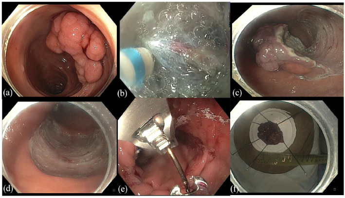 Evolving management of colorectal polyps.