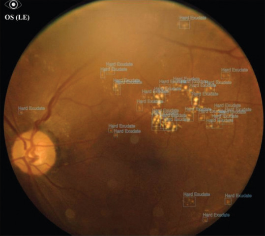 Validation of Artificial Intelligence Algorithm in the Detection and Staging of Diabetic Retinopathy through Fundus Photography: An Automated Tool for Detection and Grading of Diabetic Retinopathy.