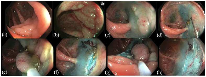 Evolving management of colorectal polyps.