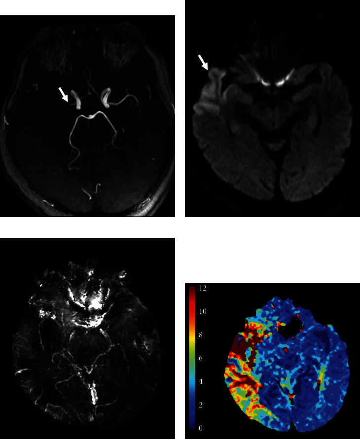 The Frequency and Associated Factors of Asymmetrical Prominent Veins: A Predictor of Unfavorable Outcomes in Patients with Acute Ischemic Stroke.