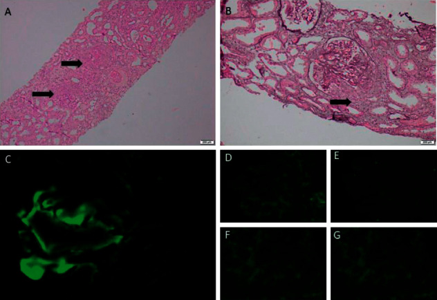 <i>Mycoplasma pneumoniae</i> Infection Associated C3 Glomerulopathy Presenting as Severe Crescentic Glomerulonephritis.