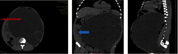 Unilateral Giant Hydronephrosis Secondary to Ureteropelvic Junction Obstruction in a Middle-Aged Woman.