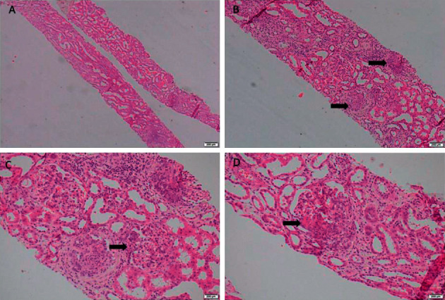 <i>Mycoplasma pneumoniae</i> Infection Associated C3 Glomerulopathy Presenting as Severe Crescentic Glomerulonephritis.