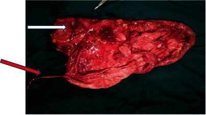 Unilateral Giant Hydronephrosis Secondary to Ureteropelvic Junction Obstruction in a Middle-Aged Woman.