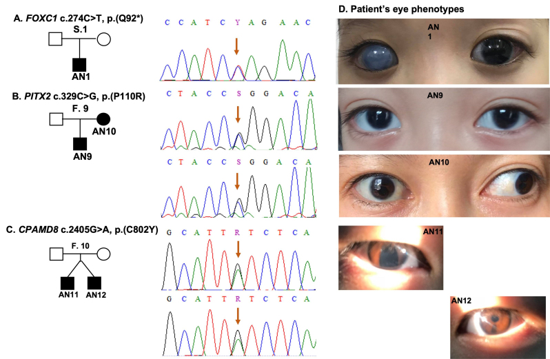 Novel mutations of the <i>PAX6</i>, <i>FOXC1</i>, and <i>PITX2</i> genes cause abnormal development of the iris in Vietnamese individuals.