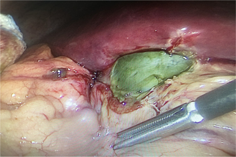 Marbelization of the gallbladder, a variant of acute gangrenous cholecystitis.