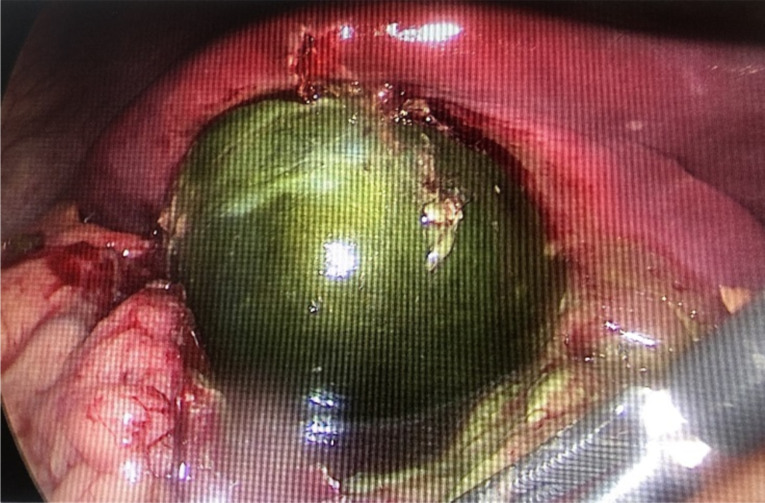 Marbelization of the gallbladder, a variant of acute gangrenous cholecystitis.