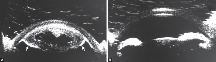 Cataract Surgery in Malignant Glaucoma from Complete Subluxation of Lens into Anterior Chamber.