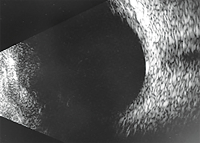 Cataract Surgery in Malignant Glaucoma from Complete Subluxation of Lens into Anterior Chamber.