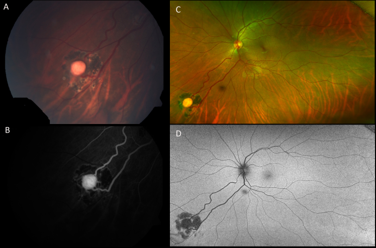 Outcome and genetic analysis of patients affected by retinal capillary hemangioblastoma in von Hippel Lindau syndrome.