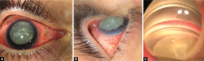 Cataract Surgery in Malignant Glaucoma from Complete Subluxation of Lens into Anterior Chamber.