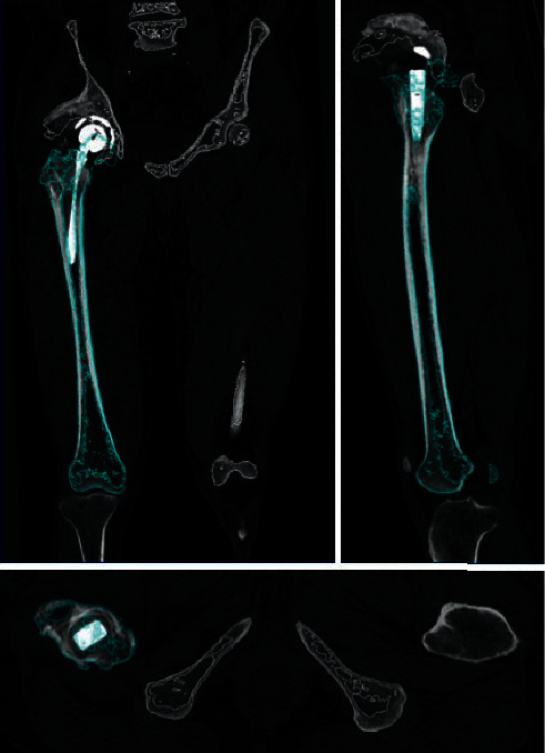 Interobserver and Intraobserver Reliabilities of Three-Dimensional Postoperative Evaluation Software in Total Hip Arthroplasty.