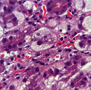 A Rare Disease Presenting Postpartum: Acute Fatty Liver of Pregnancy.