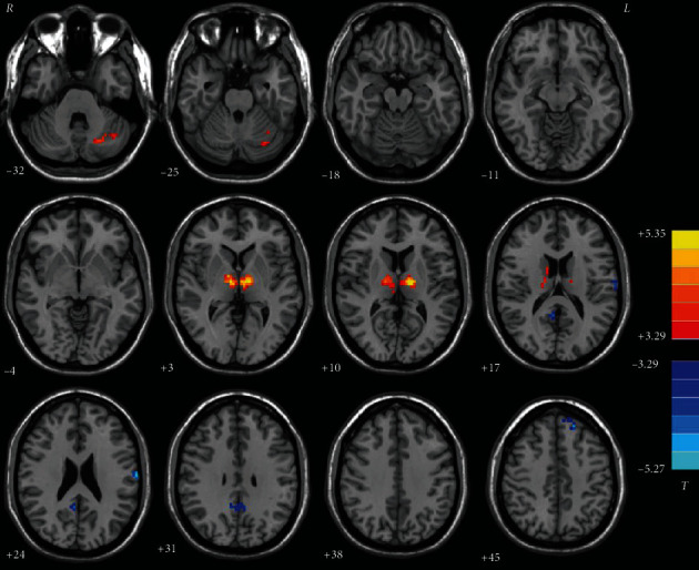 Altered Functional Connectivity Strength at Rest in Medication-Free Obsessive-Compulsive Disorder.