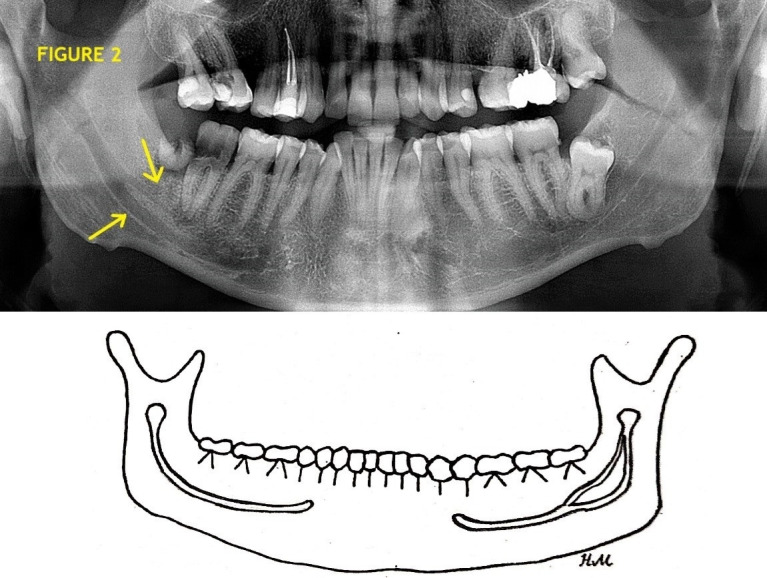 Anatomical Variations of the Bifid Mandibular Canal on Panoramic Radiographs in Citizens from Zagreb, Croatia.