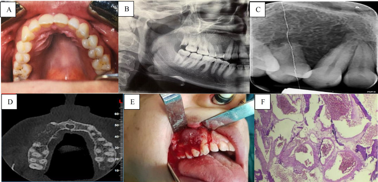 Clinical, Radiographic and Histological Assessments of a Rare Case of Intraosseous Arteriovenous Malformation in Maxilla Occurred During Pregnancy: A Case Report.