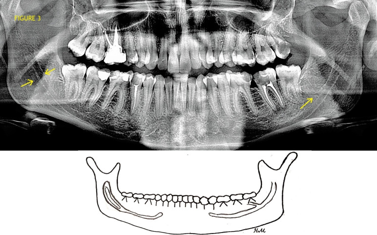 Anatomical Variations of the Bifid Mandibular Canal on Panoramic Radiographs in Citizens from Zagreb, Croatia.