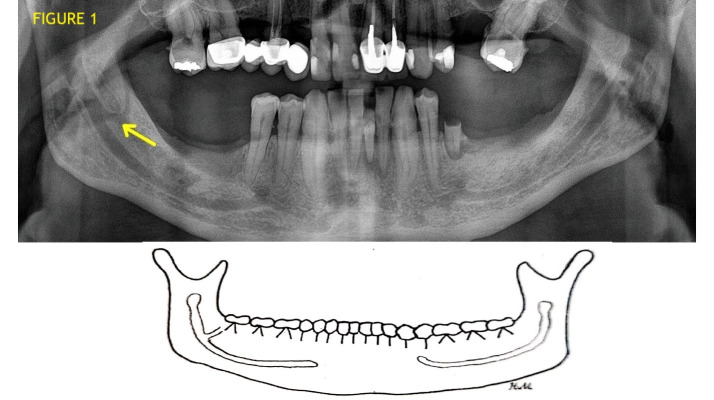 Anatomical Variations of the Bifid Mandibular Canal on Panoramic Radiographs in Citizens from Zagreb, Croatia.