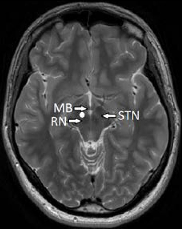 Deep brain stimulation of the medial forebrain bundle for treatment-resistant depression - a narrative literature review.