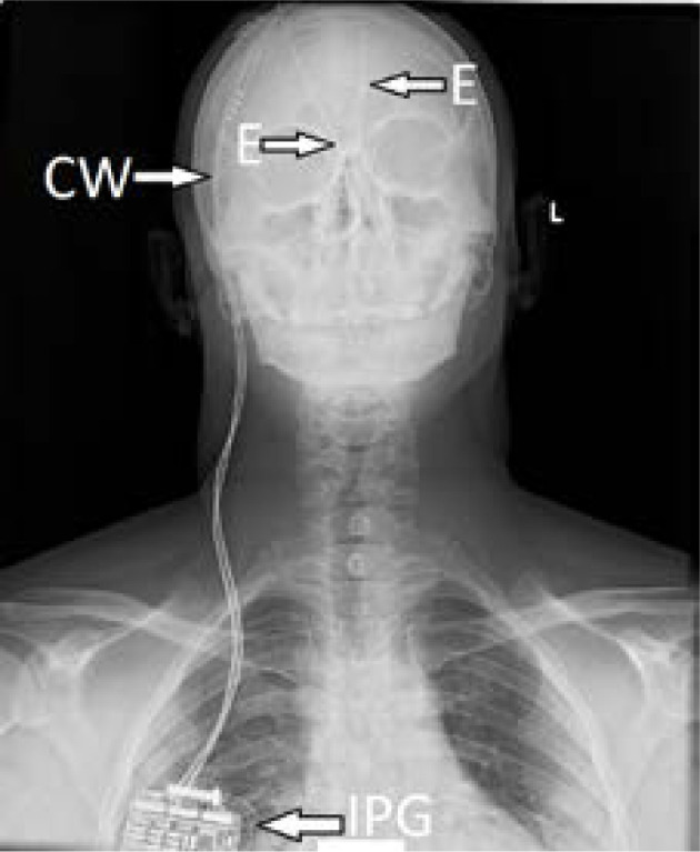 Deep brain stimulation of the medial forebrain bundle for treatment-resistant depression - a narrative literature review.